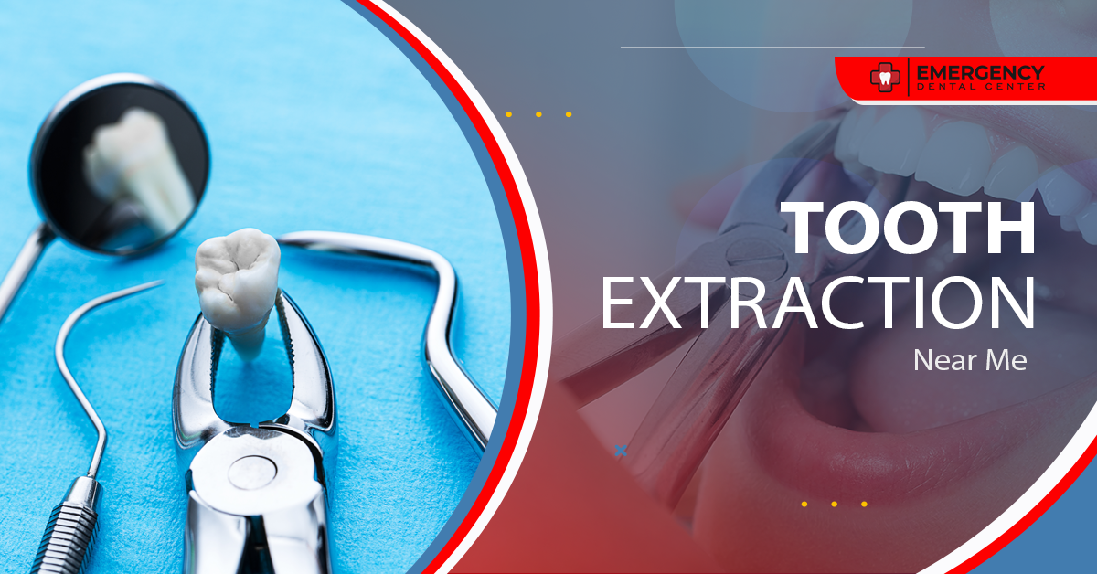 Tooth Extraction Near Me Tooth Extraction Houston